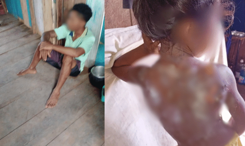 Padrasto é preso suspeito de jogar mingau quente no corpo de criança no AM